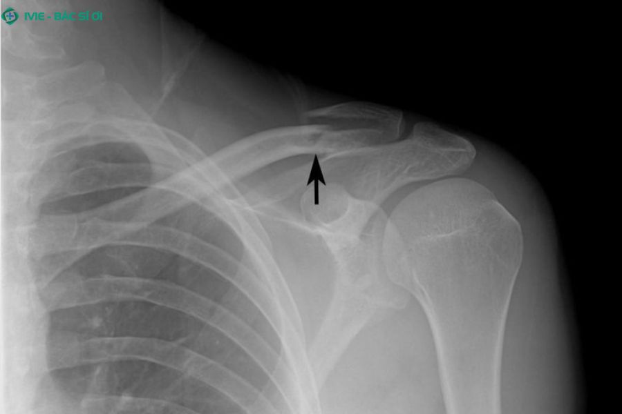 Gãy xương đòn và xương bả vai, gây đau dữ dội và hạn chế cử động tay