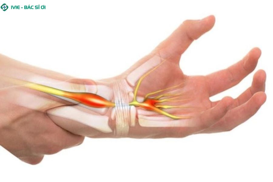 Tìm hiểu về hội chứng ống cổ tay