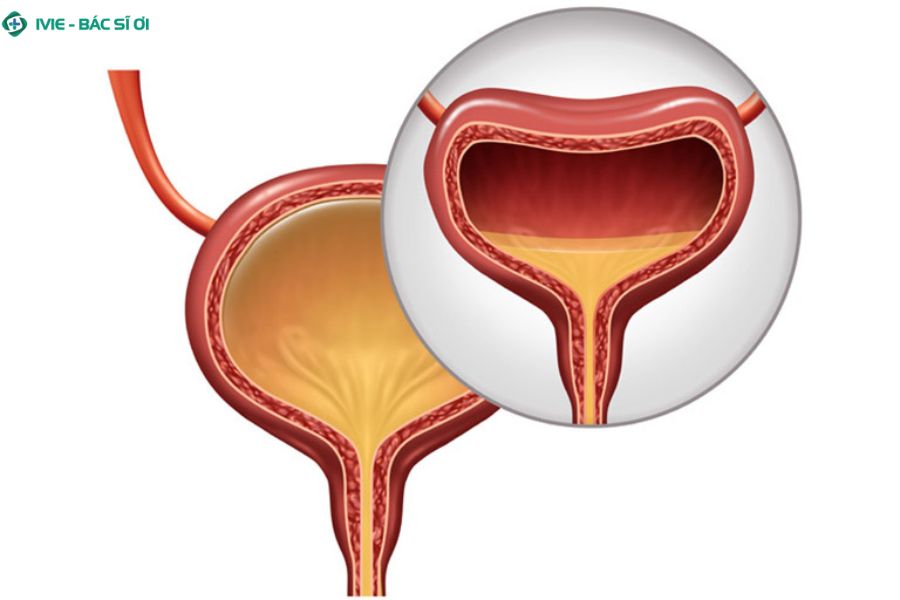 Bàng quang tăng hoạt khiến nam giới buồn tiểu liên tục, tiểu gấp dù lượng nước tiểu rất ít