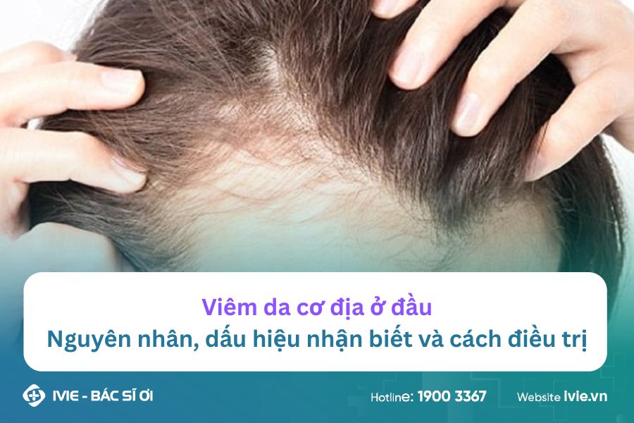 Viêm da cơ địa ở đầu: Nguyên nhân, dấu hiệu nhận biết và...
