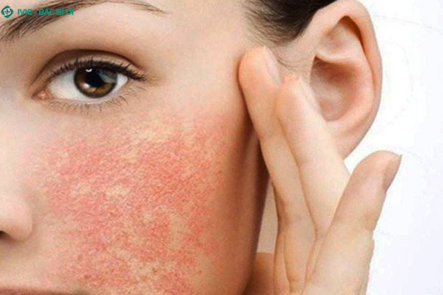 Triệu chứng đi kèm mặt nổi mẩn đỏ có thể là ngứa, nóng rát, lan rộng, sốt hoặc sưng môi mắt - cần cảnh giác cấp cứu
