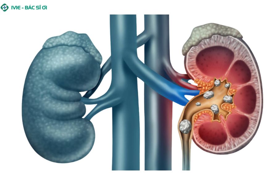 Các bệnh lý nguy hiểm có thể gây hồng cầu trong nước tiểu