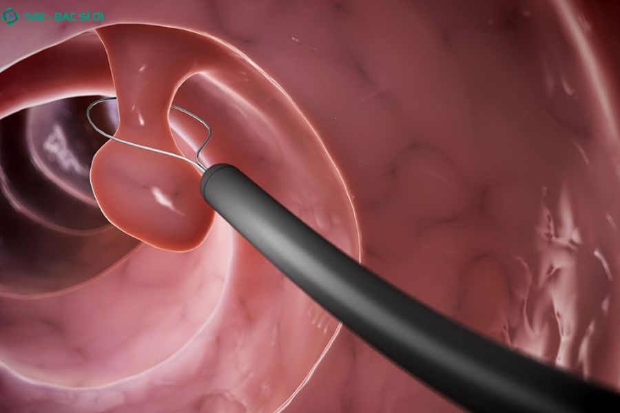 Người bệnh cần ăn uống nhẹ và theo dõi sát triệu chứng nếu đã thực hiện cắt polyp hoặc sinh thiết khi nội soi