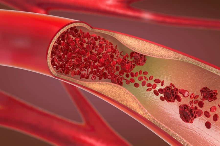 Tăng tiểu cầu có phải là ung thư máu