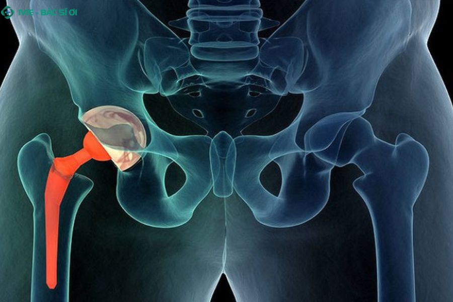 Các bệnh lý vùng háng - thoái hóa khớp háng, thoát vị bẹn