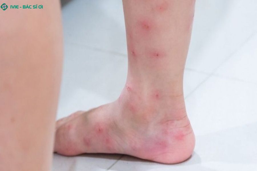 Các nốt đỏ li ti trên da chân kèm ngứa rát, khó chịu, thường tập trung thành cụm giống vết muỗi đốt
