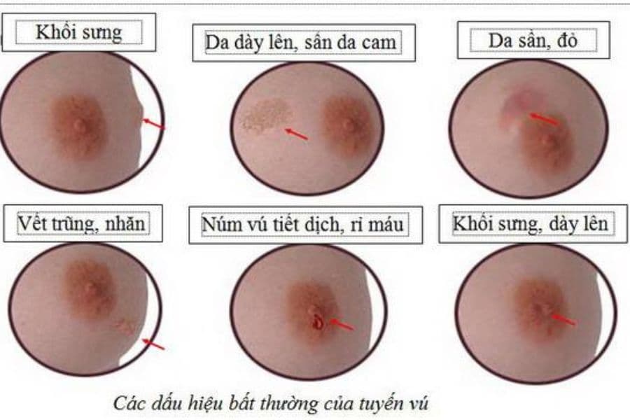 Dấu hiệu ung thư vú