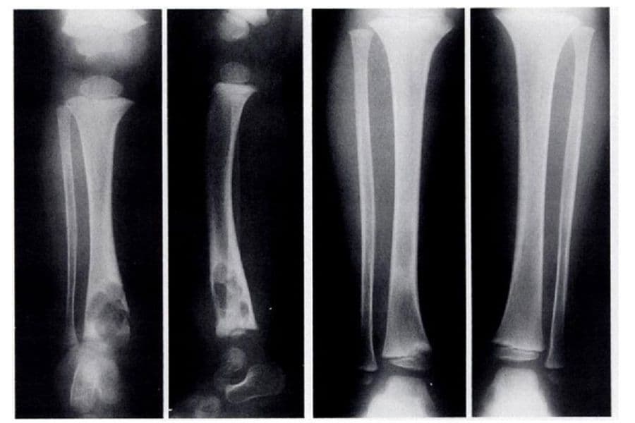 Lao xương có phải ung thư không?