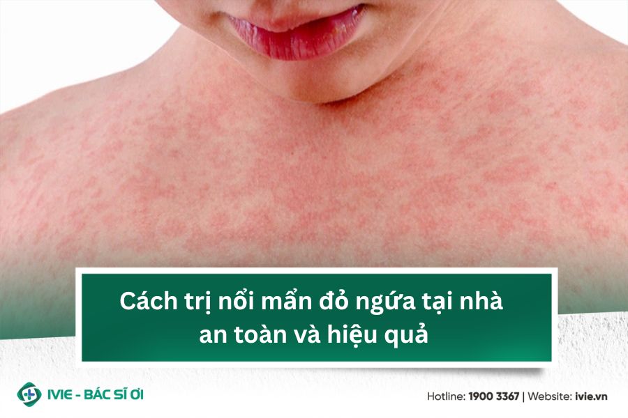 Cách trị nổi mẩn đỏ ngứa tại nhà an toàn và hiệu quả