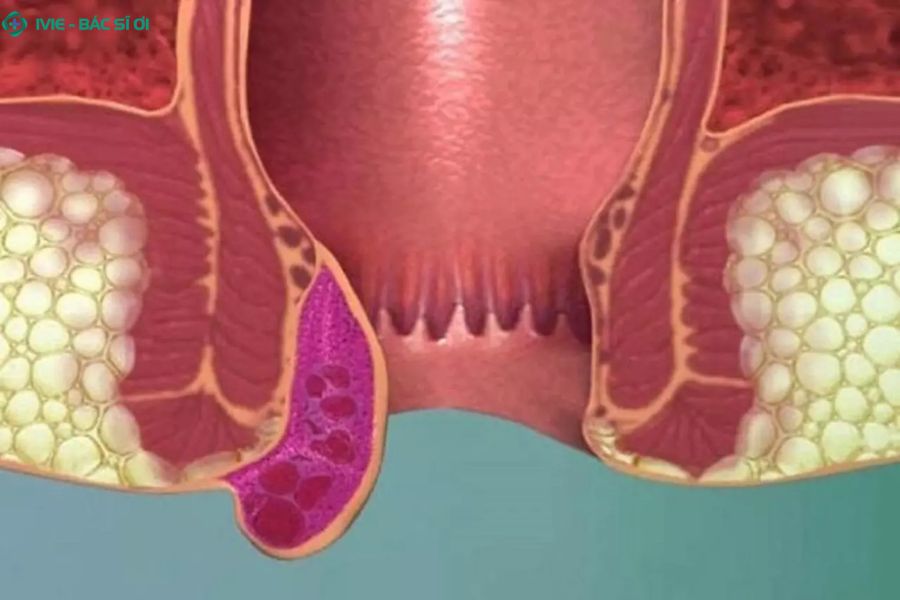 Tìm hiểu dấu hiệu trĩ độ 3