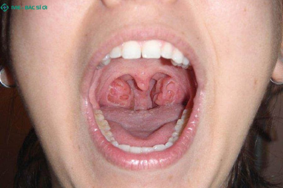 Các yếu tố ảnh hưởng đến thời gian hồi phục viêm amidan ở trẻ