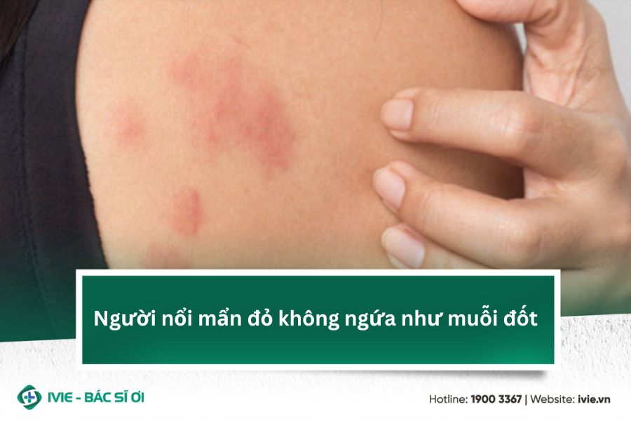 Người nổi mẩn đỏ không ngứa như muỗi đốt