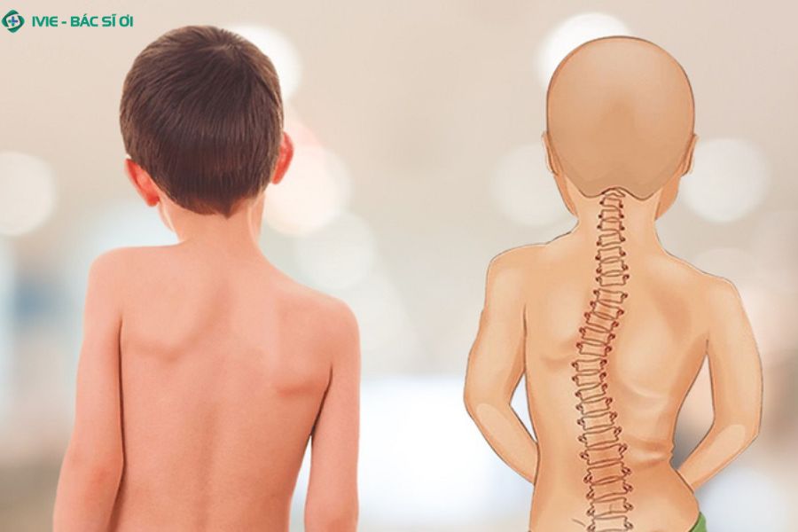 Cong vẹo cột sống học đường thường khởi phát âm thầm, cần quan sát kỹ tư thế và dáng đi của học sinh để phát hiện sớm