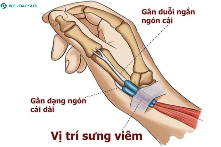 Đau ngón tay cái sau khi ngủ dậy cẩn thận với viêm khớp, hội chứng ống cổ tay hoặc gout