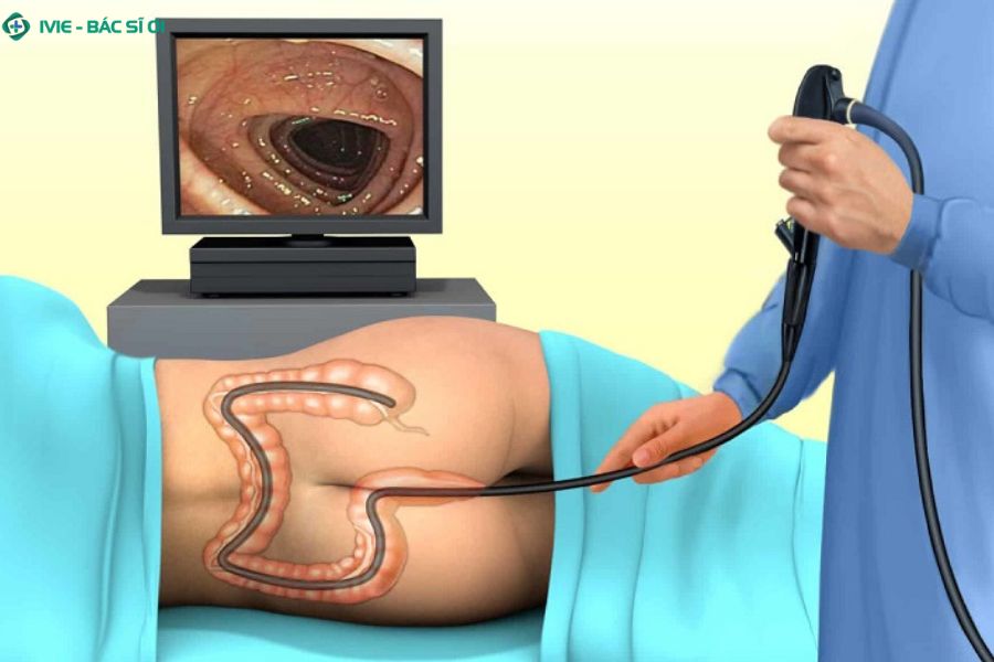 Nhiều người có thắc mắc nội soi đại tràng để làm gì?