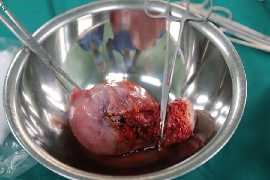 Chỉ định phẫu thuật u xơ tử cung được bác sĩ chuyên khoa cân nhắc kỹ lưỡng dựa trên kích thước phối hợp với triệu chứng biến chứng thực tế