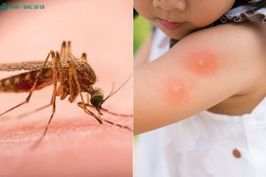 Nổi mẩn đỏ do côn trùng cắn ở trẻ xử lý như thế nào