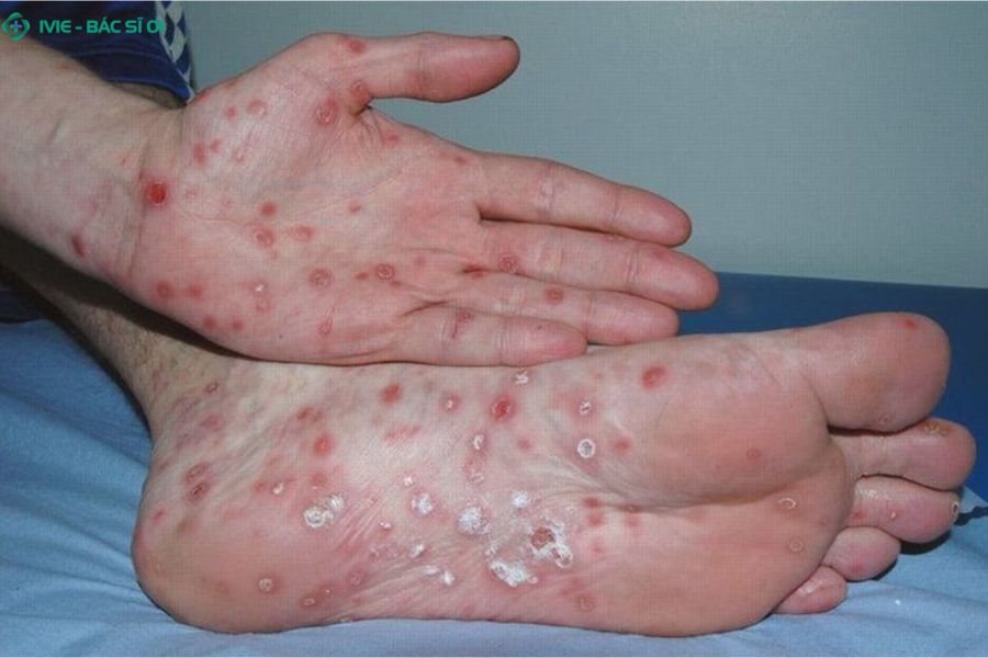 Thăm khám sớm giúp xác định chính xác loại bệnh tình dục nam giới đang mắc phải