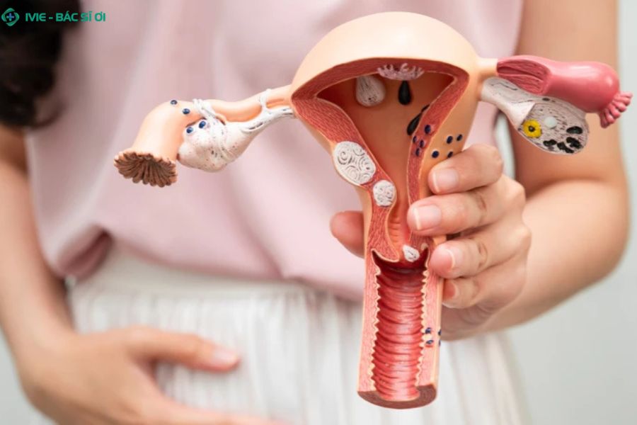 Viêm lộ tuyến cổ tử cung không thể tự khỏi mà tiến triển nặng dần theo thời gian nếu không điều trị đúng cách
