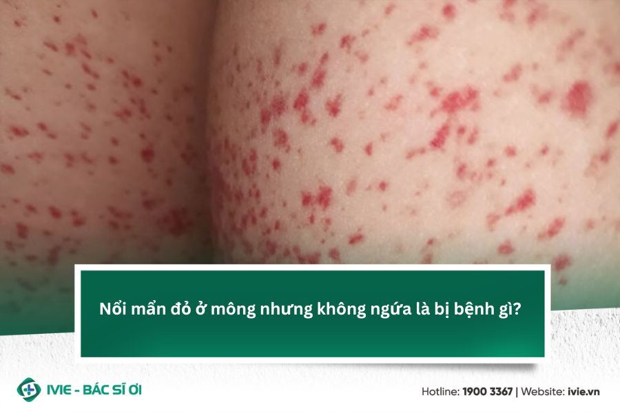 Nổi mẩn đỏ ở mông nhưng không ngứa là bị bệnh gì?