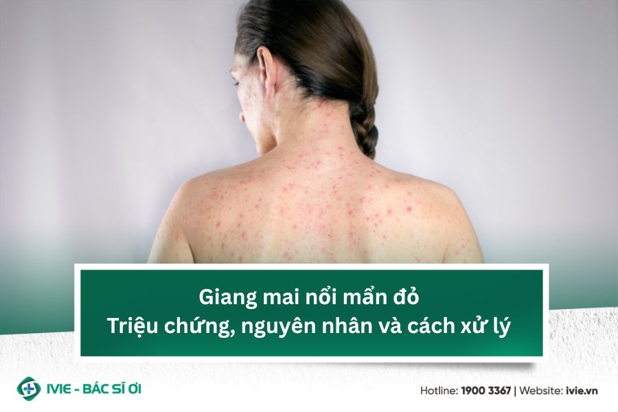 Giang mai nổi mẩn đỏ - Triệu chứng, nguyên nhân và cách xử...