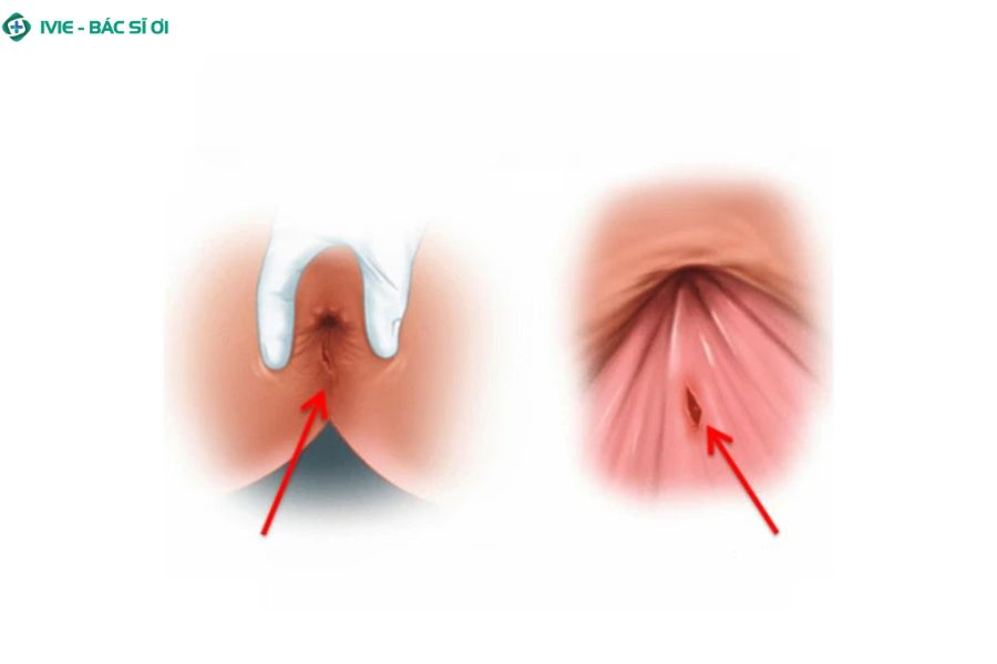 Cấu tạo niêm mạc hậu môn rất mỏng và dễ bị tổn thương nếu không có đủ chất bôi trơn khi quan hệ