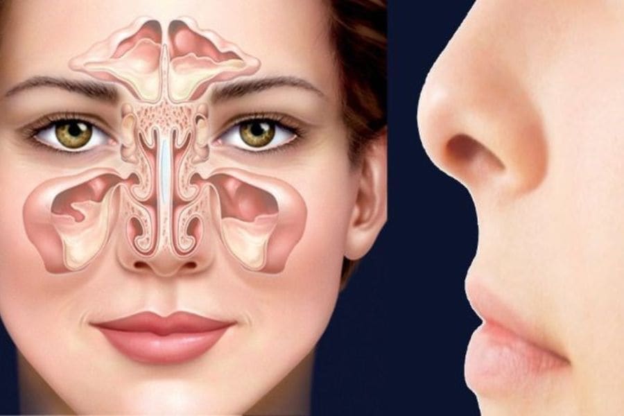 Ung thư mũi và xoang có hiện tượng chảy máu cam