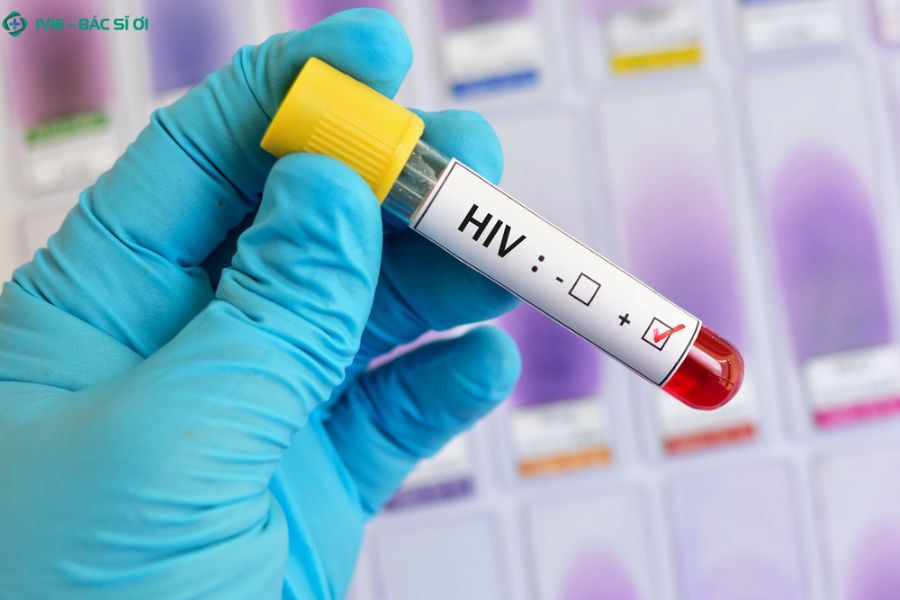 Mốc thời gian nên đi xét nghiệm HIV