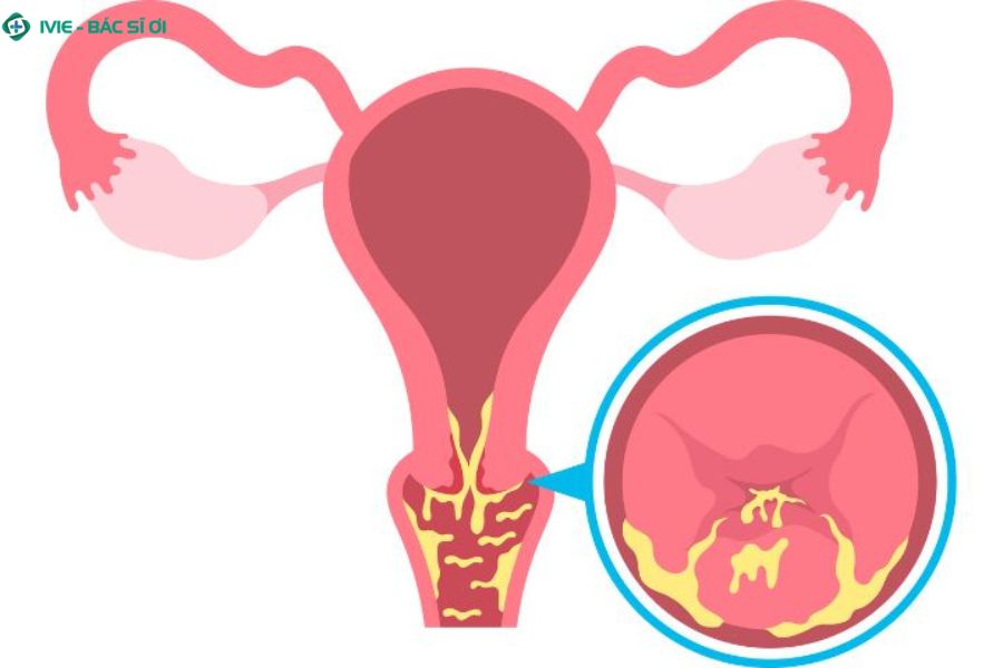 Cơ chế vi khuẩn tấn công vùng lộ tuyến cổ tử cung gây viêm nhiễm