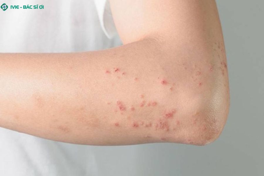 Đặc điểm thường gặp khi tay nổi mẩn đỏ không ngứa