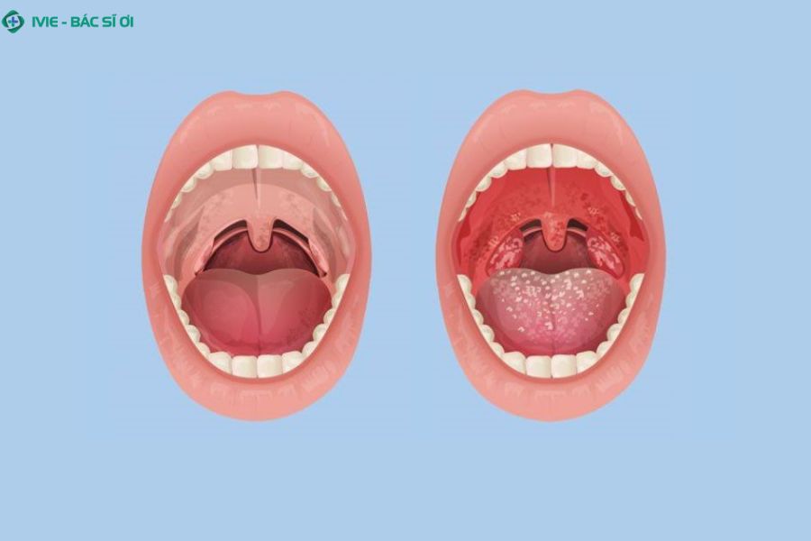 Nguyên nhân gây viêm amidan ở trẻ: Virus, vi khuẩn và các yếu tố khác