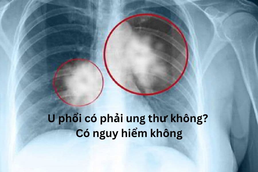 U phổi có phải ung thư không? Có nguy hiểm không?