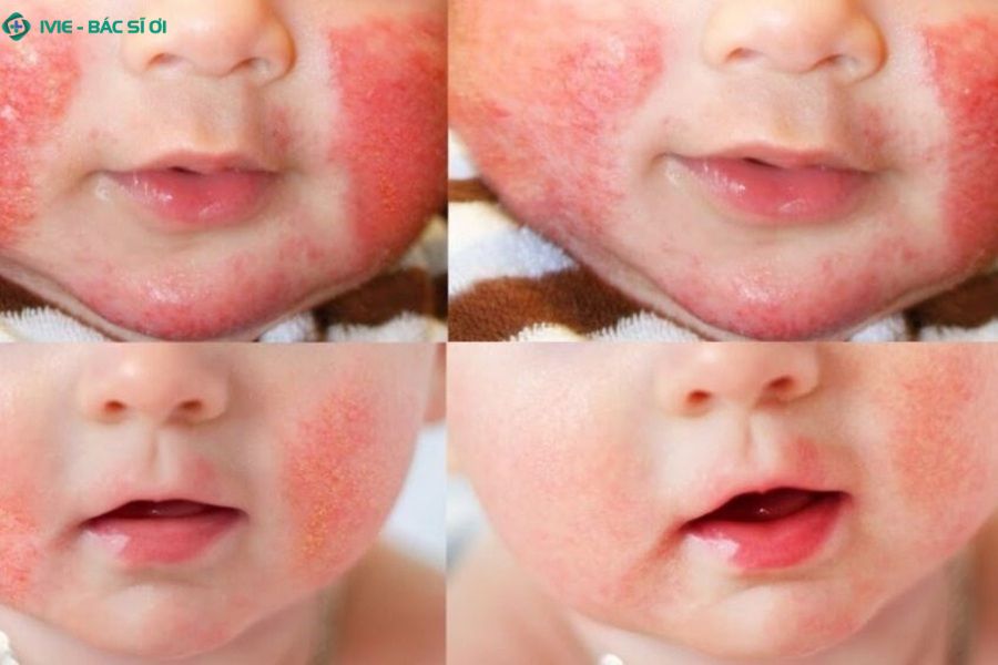 Dấu hiệu viêm da cơ địa ở trẻ nhũ nhi