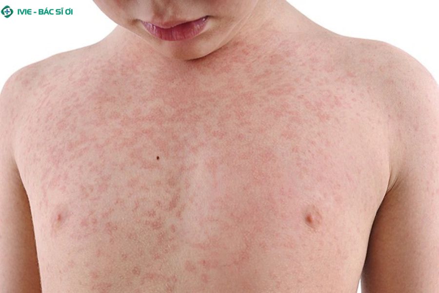 Tìm hiểu về bệnh sởi và Rubella