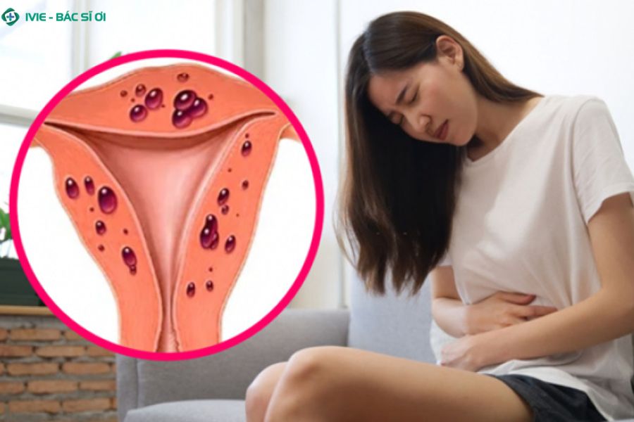 Lạc nội mạc tử cung có thể gây đau kéo dài, rối loạn kinh nguyệt và làm tăng nguy cơ khó mang thai