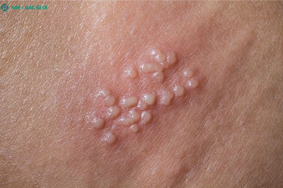 Tìm hiểu về các bệnh lây truyền qua đường tình dục phổ biến ở người đồng giới