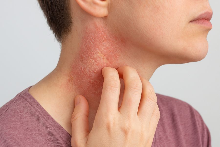 Biến chứng viêm da cơ địa ở cổ: tổn thương da, thâm sẹo và ảnh hưởng tâm lý