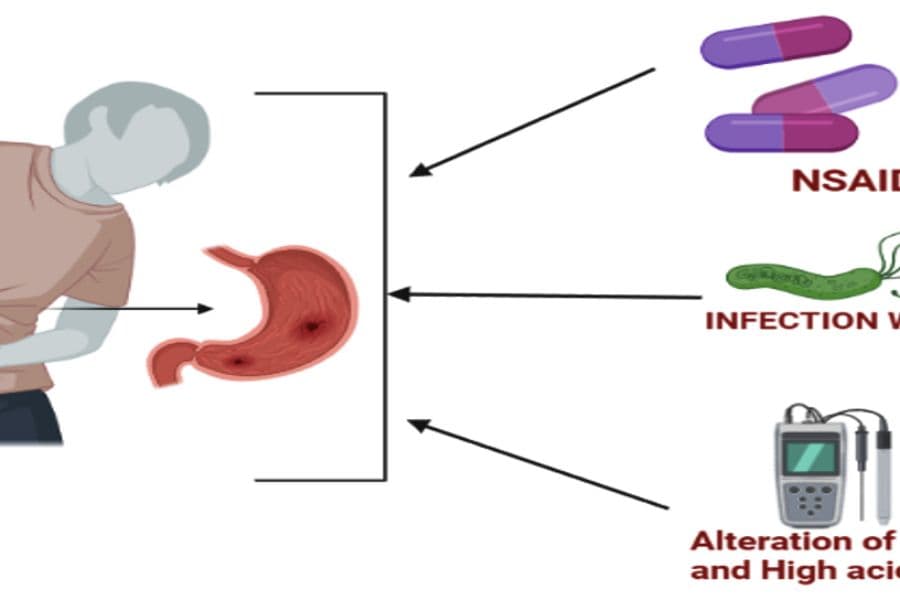 Polyp dạ dày có phải là ung thư không?