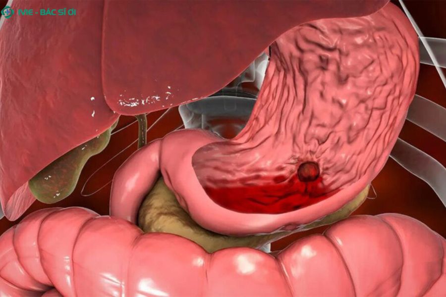 Ngay cả khi triệu chứng đã hết, bạn vẫn nên tái khám định kỳ để kiểm tra tình trạng niêm mạc và xử lý sớm nếu bệnh có dấu hiệu quay lại