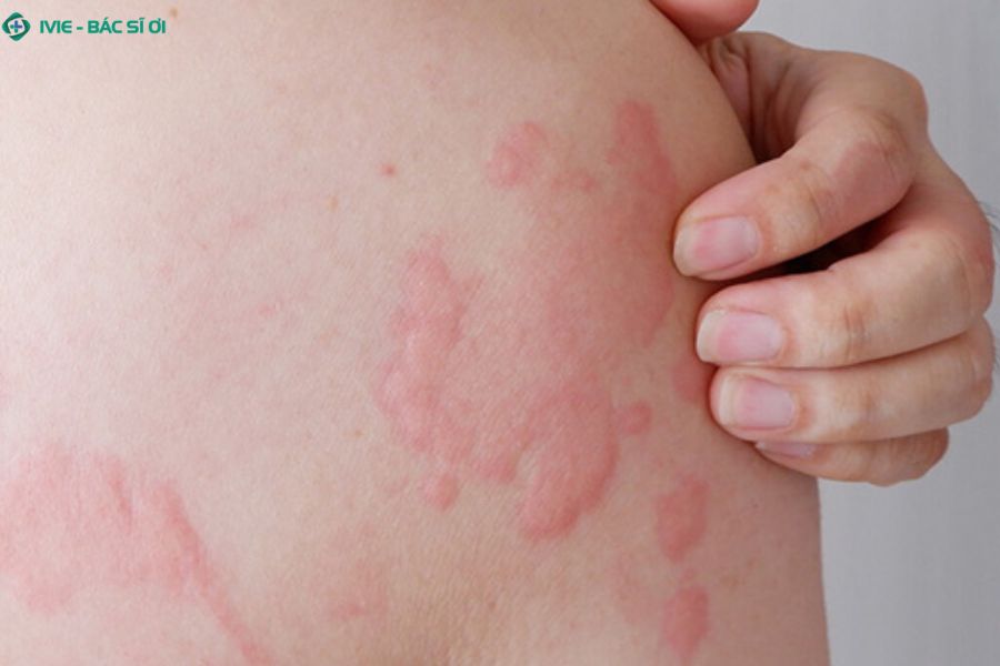 Trường hợp ngứa nổi mẩn đỏ kèm khó thở, phù mặt cần đi khám ngay để tránh biến chứng sốc phản vệ