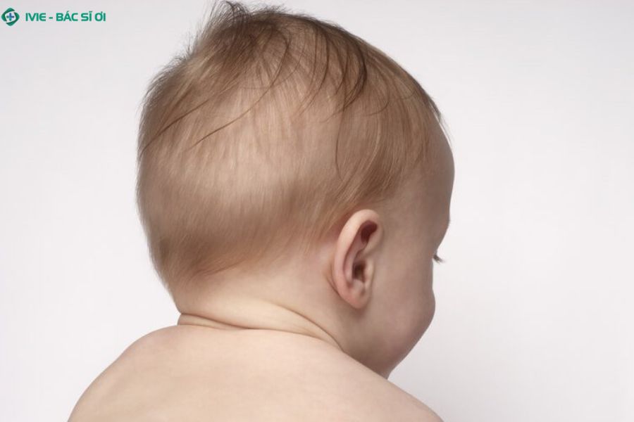 Rụng tóc vành khăn ở trẻ 3 tháng tuổi là gì?