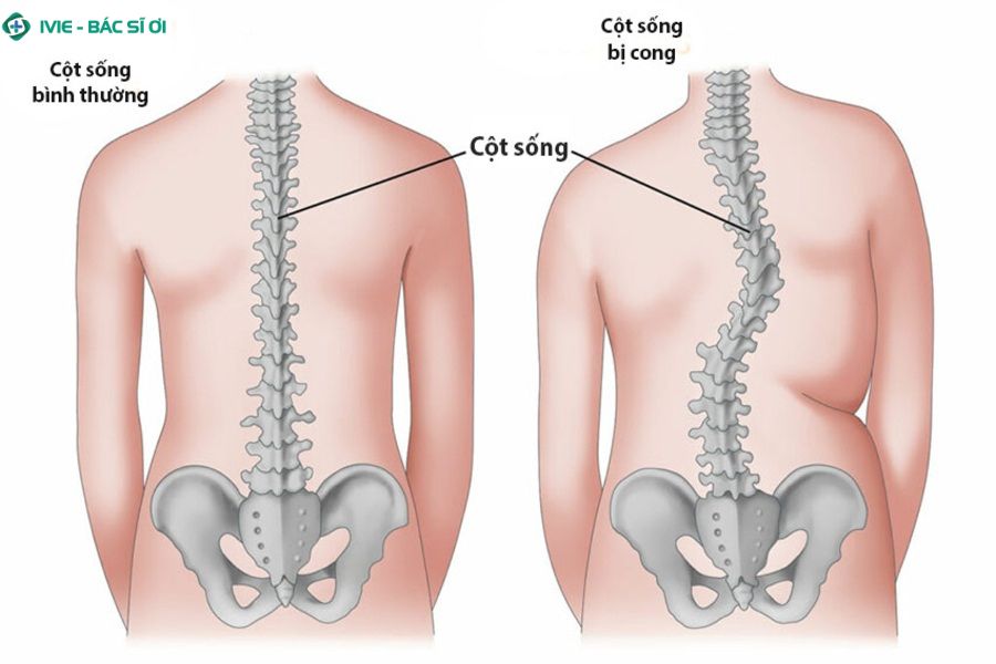 Dấu hiệu của thoát vị đĩa đệm bạn cần để ý