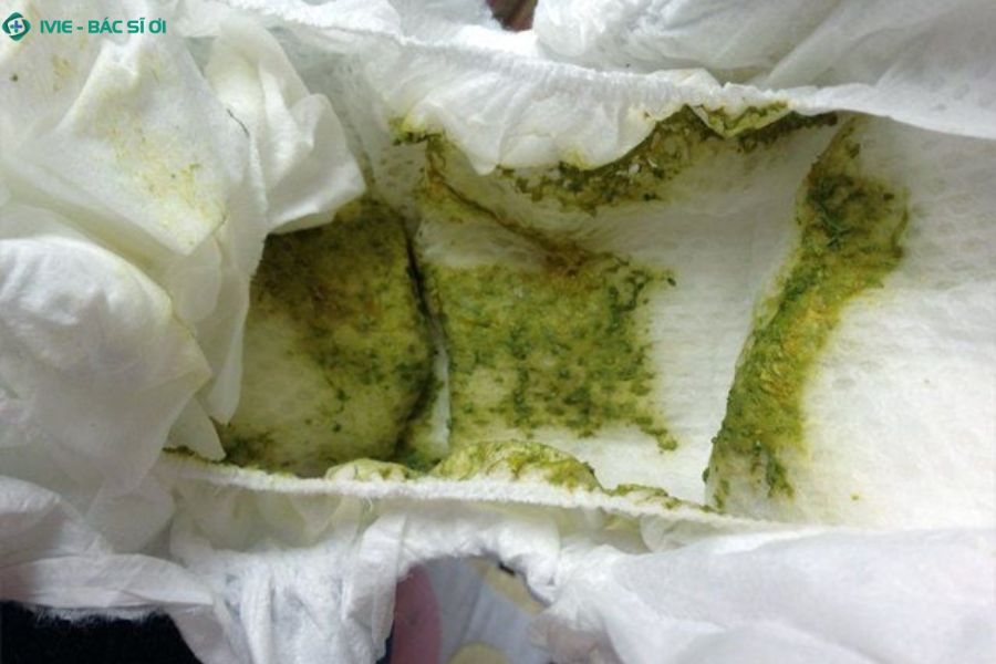 Trẻ 2 tháng tuổi đi ngoài màu xanh rêu gây ra nhiều lo lắng đối với cha mẹ