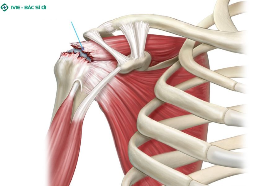 Cơ chóp xoay vai tổn thương tại đây có thể gây đau lan lên cổ