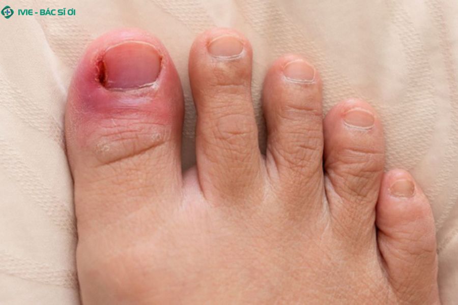Ngón chân sưng đỏ, đau nhức và có mủ là dấu hiệu của viêm nhiễm cấp tính, cần được xử trí kịp thời