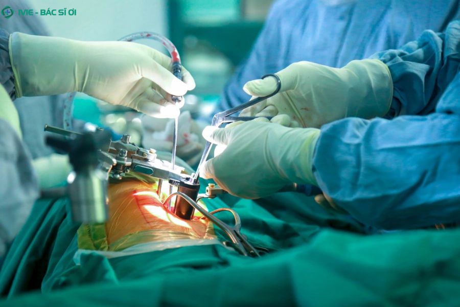 Phẫu thuật điều trị gù lưng nặng giúp chỉnh lại cấu trúc cột sống và ngăn ngừa biến chứng về thần kinh, hô hấp