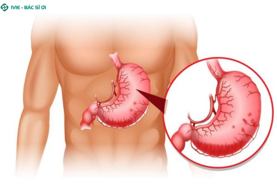 Xuất huyết dạ dày có thể gây tử vong nếu mất máu nhiều, sốc hoặc biến chứng nặng mà không được cấp cứu kịp thời