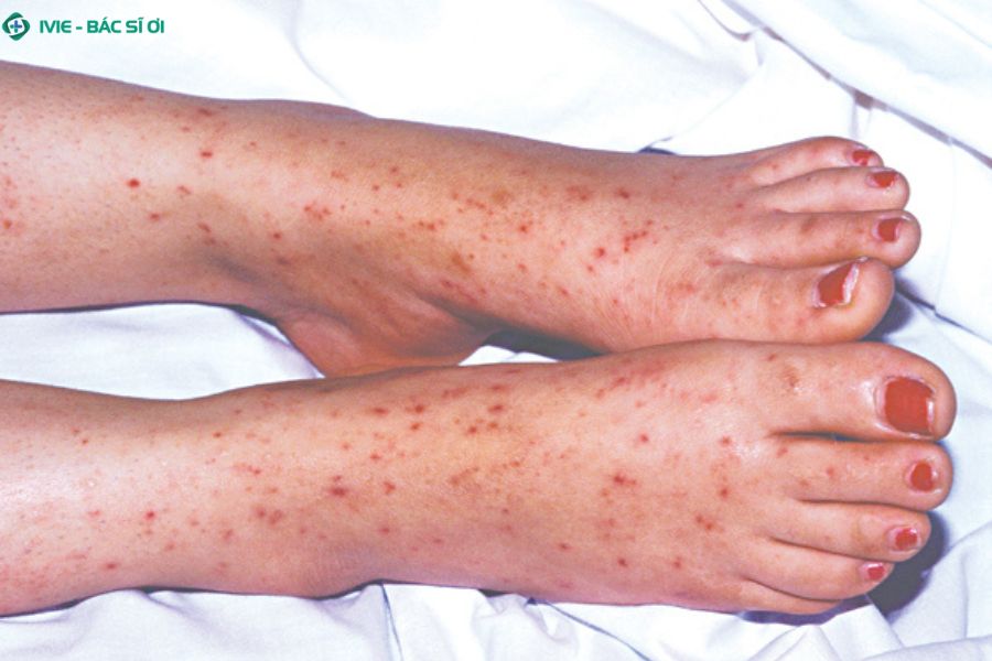 Dấu hiệu nhận biết viêm não mô cầu sớm