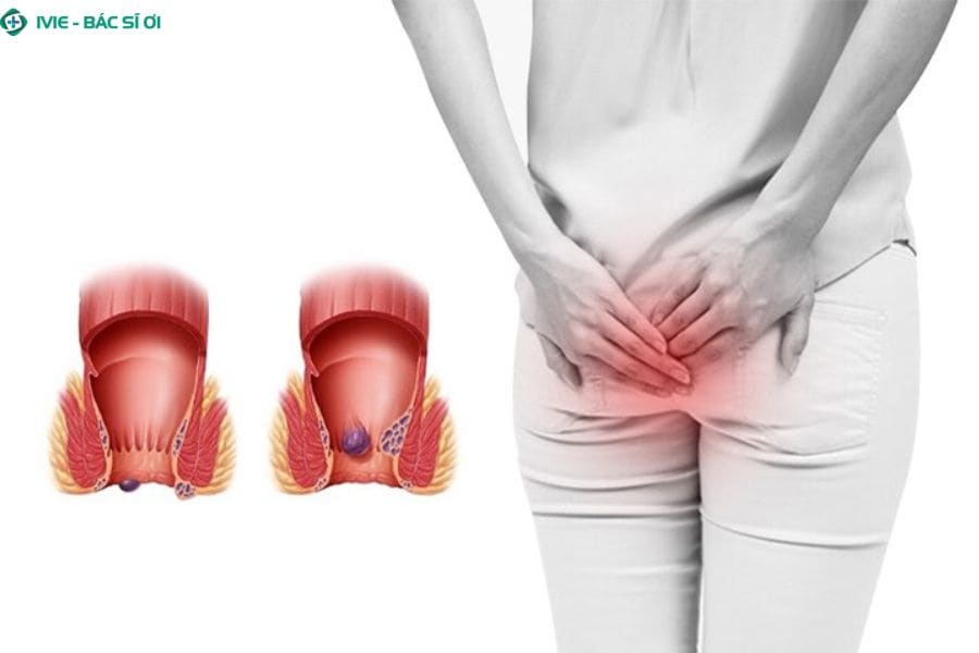Bệnh trĩ và nứt kẽ hậu môn là hai tác nhân cơ học hàng đầu gây đại tiện máu tươi