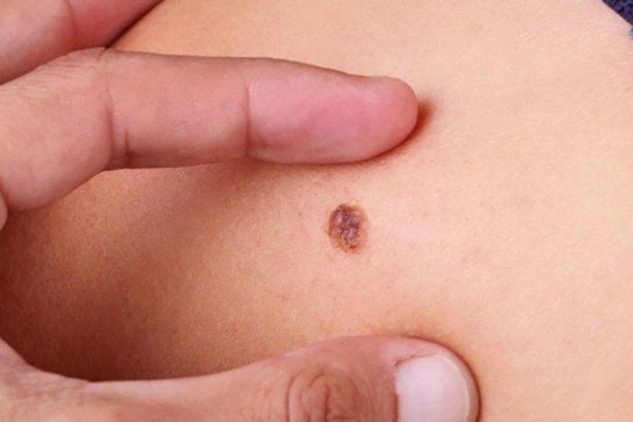 Sự thay đổi bất thường của các nốt ruồi cảnh báo nguy cơ ung thư hắc tố